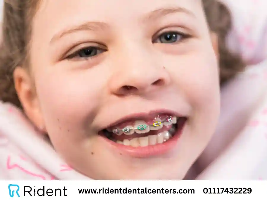 تقويم الاسنان للاطفال